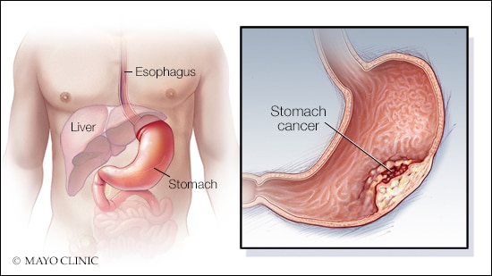 a-medical-illustration-of-stomach-cancer